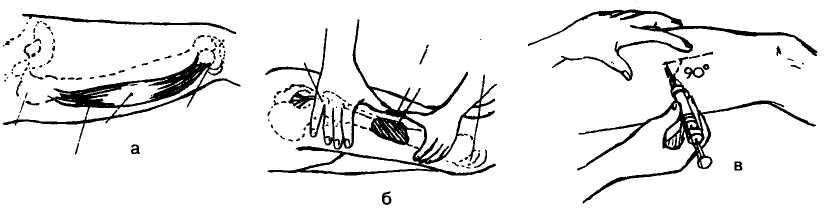 Можно ставить уколы в ногу. Техника постановки внутримышечной инъекции в бедро. Внутримышечный укол в бедро техника. Схема внутримышечной инъекции в бедро. Постановка внутримышечной инъекции в бедро алгоритм.
