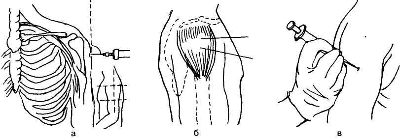 Гексаред. Внутримышечная инъекция в плечо техника. Дельтовидная мышца плеча Введение вакцины. Дельтовидная мышца внутримышечная инъекция. Техника внутримышечной инъекции в дельтовидную мышцу плеча.