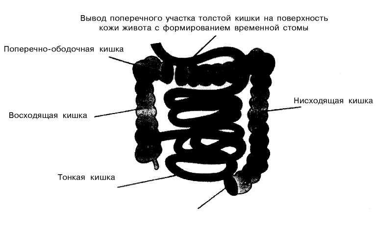 12.2. Уход за стомами кишечника (рис. 12.4—12.6).