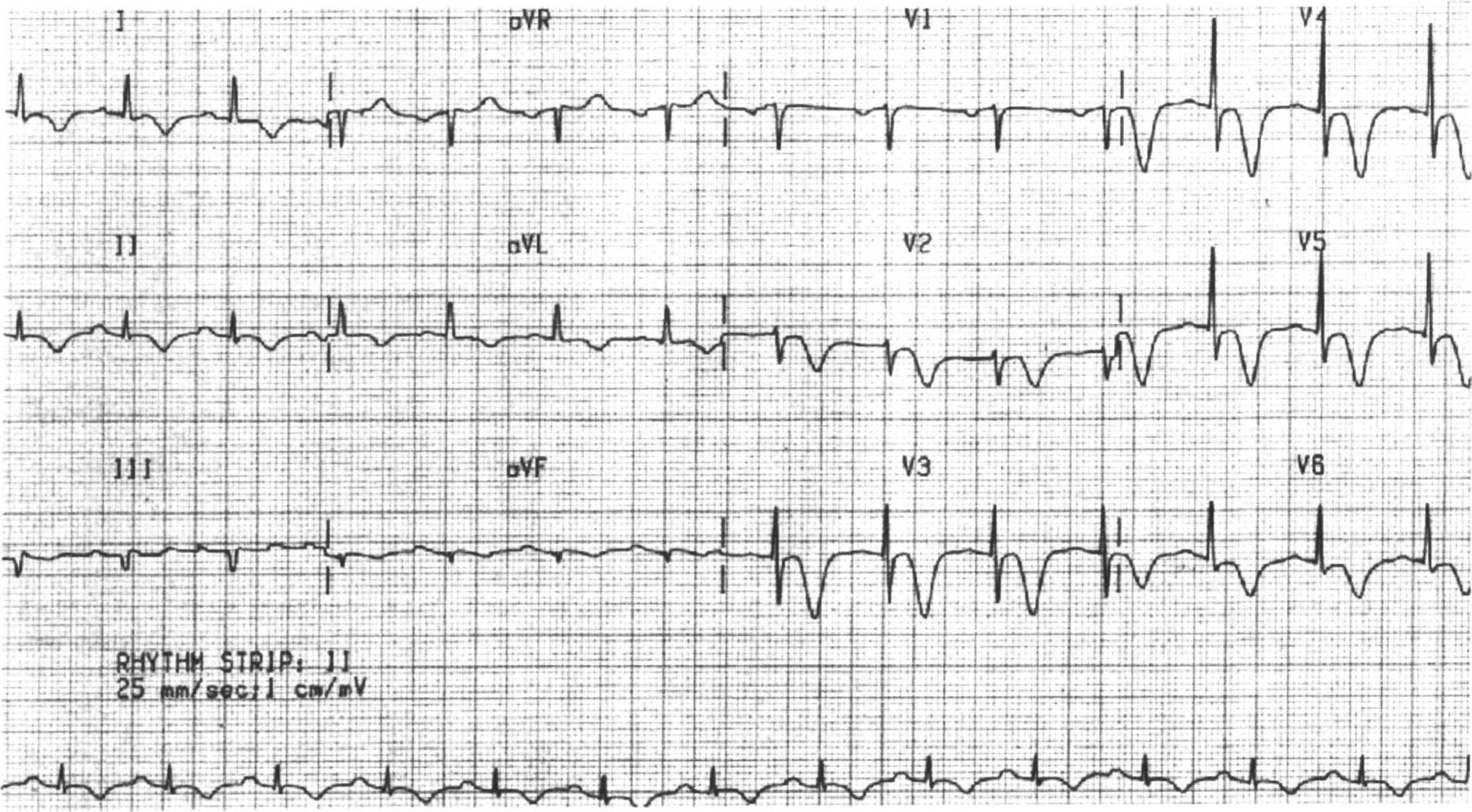 Изменение боковой стенки левого желудочка. Интрамуральный инфаркт миокарда на ЭКГ. Инфаркт миокарда передней стенки ЭКГ. ЭКГ при q инфаркте миокарда. Подострая стадия инфаркта миокарда на ЭКГ.