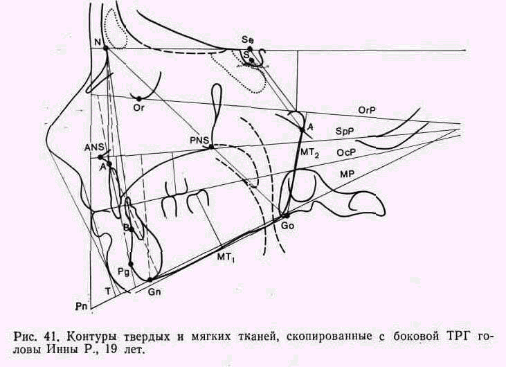 Угол spp mp. Точка NSL на ТРГ. Точка PG на ТРГ. Антропометрические точки ортодонтия. Нижнечелюстной угол ТРГ.