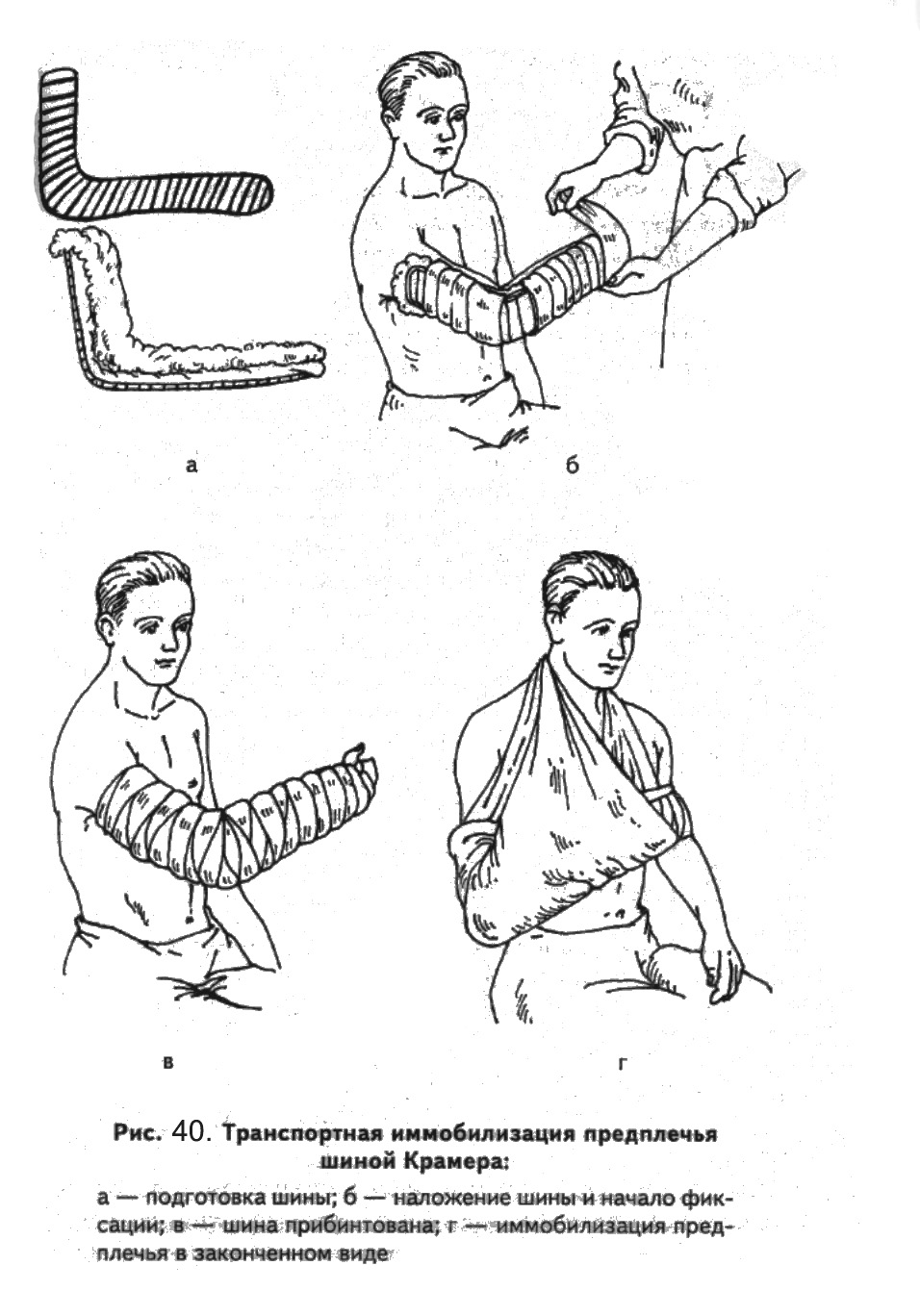 Шина крамера алгоритм. Шина Крамера при переломе костей предплечья. Иммобилизация предплечья шиной Крамера. Выполнить транспортную иммобилизацию предплечья шиной Крамера. Транспортная иммобилизация лестничной шиной при переломе предплечья.