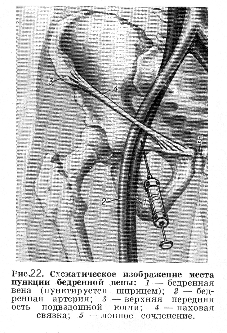 Катетеризация бедренной. Пункция артерии по Сельдингеру. Бедренная Вена пункция. Паховая Вена катетеризация. Пункция бедренной артерии по Сельдингеру.