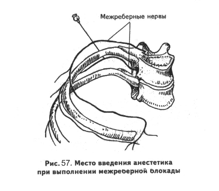 Блокады при переломах. Паравертебральная блокада межреберных нервов. Спирто новокаиновая блокада при переломе ребер. Межреберная новокаиновая блокада показания техника. Новокаиновые блокады перелом ребер.