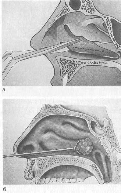 Нижняя подслизистая вазотомия. Вазотомия+подслизистая резекция носовой перегородки. Подслизистая вазотомия носовых раковин. Вазомоторный ринит операция.