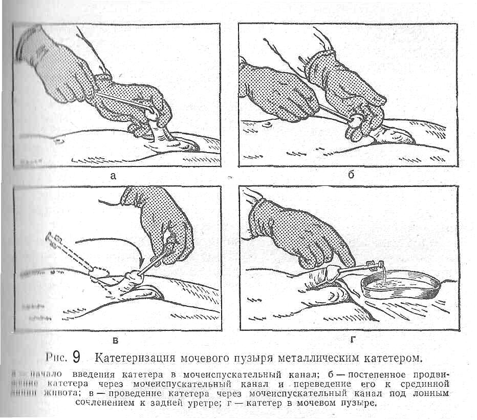 Алгоритм введения катетера. Алгоритм использования мочевого катетера. Катетеризация мочевого пузыря у мужчин алгоритм. Постановка мочевого катетера алгоритм. Техника катетеризации мочевого пузыря мягким катетером алгоритм.