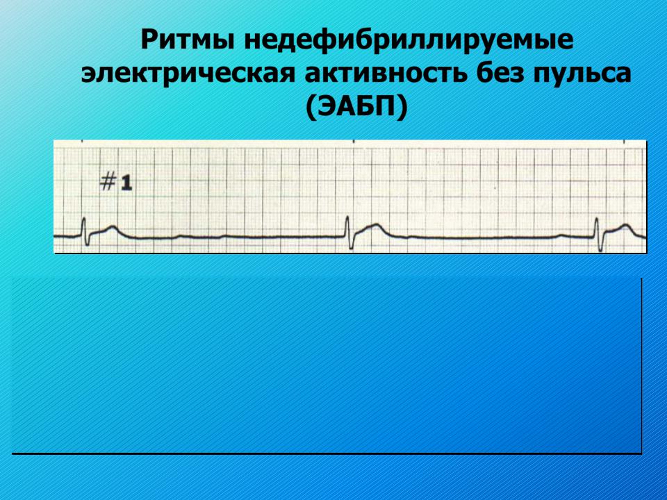 Электрическая активность без пульса