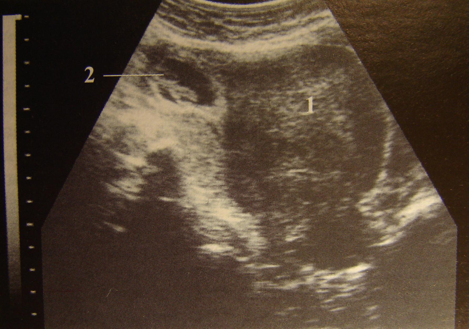 На узи видно внематочную. Внематочная Трубная беременность УЗИ. Внематочная беременность снимки УЗИ. Трубная беременность УЗИ. Внематочная беременность на УЗИ фото.