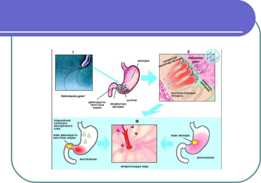 Язвенная болезнь патогенез схема