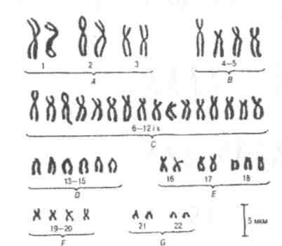 Хромосомные синдромы числовыми аномалиями аутосом