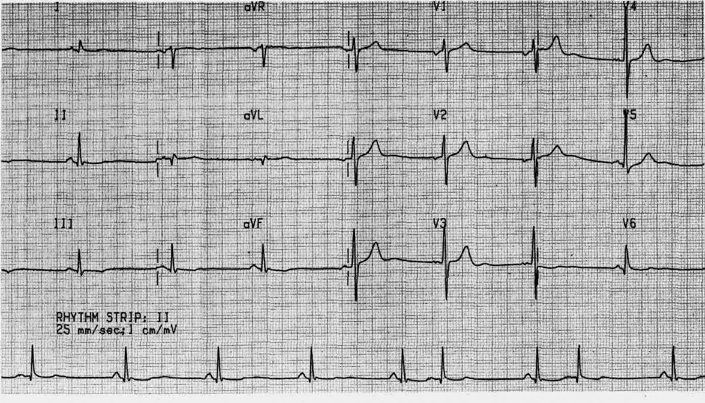 Неспецифические изменения нижней стенки. Нормальный ритм на ЭКГ. ЭКГ ритм 80. ЭКГ пример. Кардиограмма сердца.