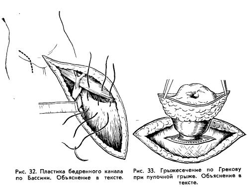 Пластика бедренного канала