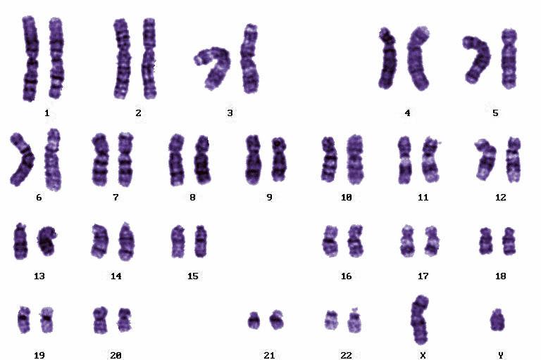 Спаривание хромосом. Хромосомные мутации. Хромосомы человека. Мутированные хромосомы. Поврежденная хромосома.