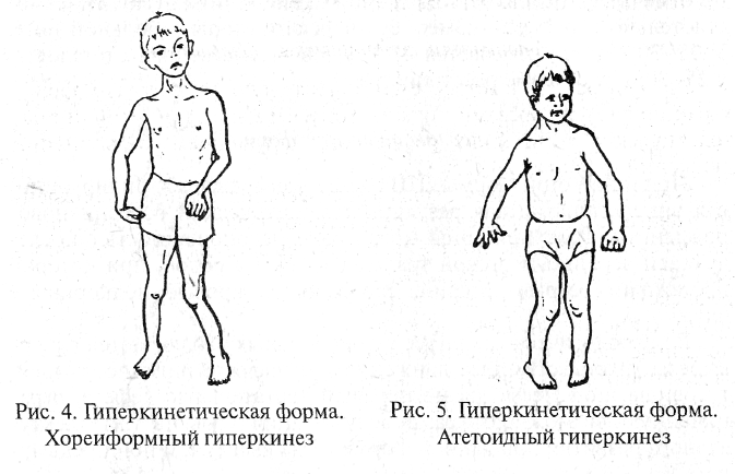 Гиперкинетическую дцп. Гиперкинетическая форма. Детский церебральный паралич гиперкинетическая форма. Спастико-гиперкинетическая форма ДЦП. Гиперкинезы у детей до года.