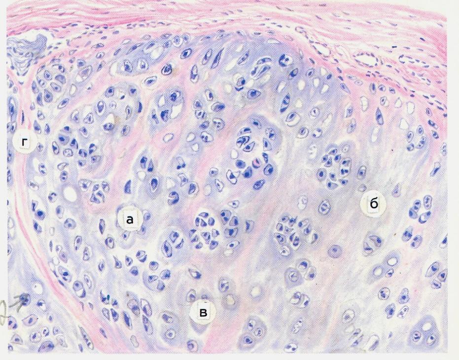 Кавернозная гемангиома печени (Haemangioma cavernosa hepatis).