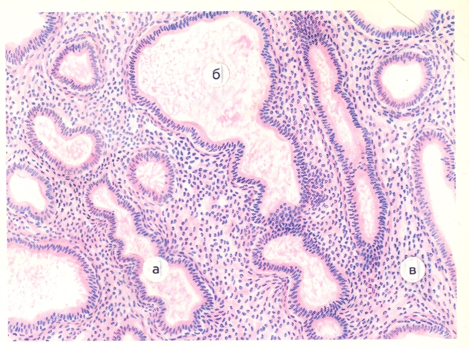 Кистозно расширенные железы. Гиперплазия эндометрия микропрепарат. Железисто-кистозная гиперплазия эндометрия микропрепарат. Железистая гиперплазия эндометрия патанатомия. Железы эндометрия матки гистология.
