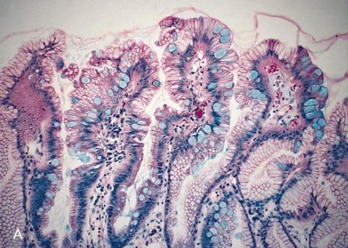 Перстневидноклеточный рак желудка микропрепарат