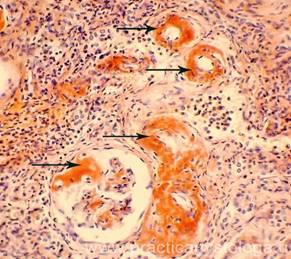 Перстневидноклеточный рак желудка микропрепарат