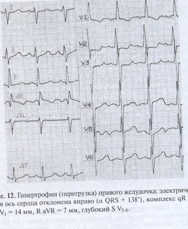 Перегрузка левого желудочка. ЭКГ при гипертрофии правого желудочка. Гипертрофия правого желудочка сердца на ЭКГ. Гипертрофия миокарда правого желудочка. Гипертрофия левого и правого желудочка на ЭКГ.