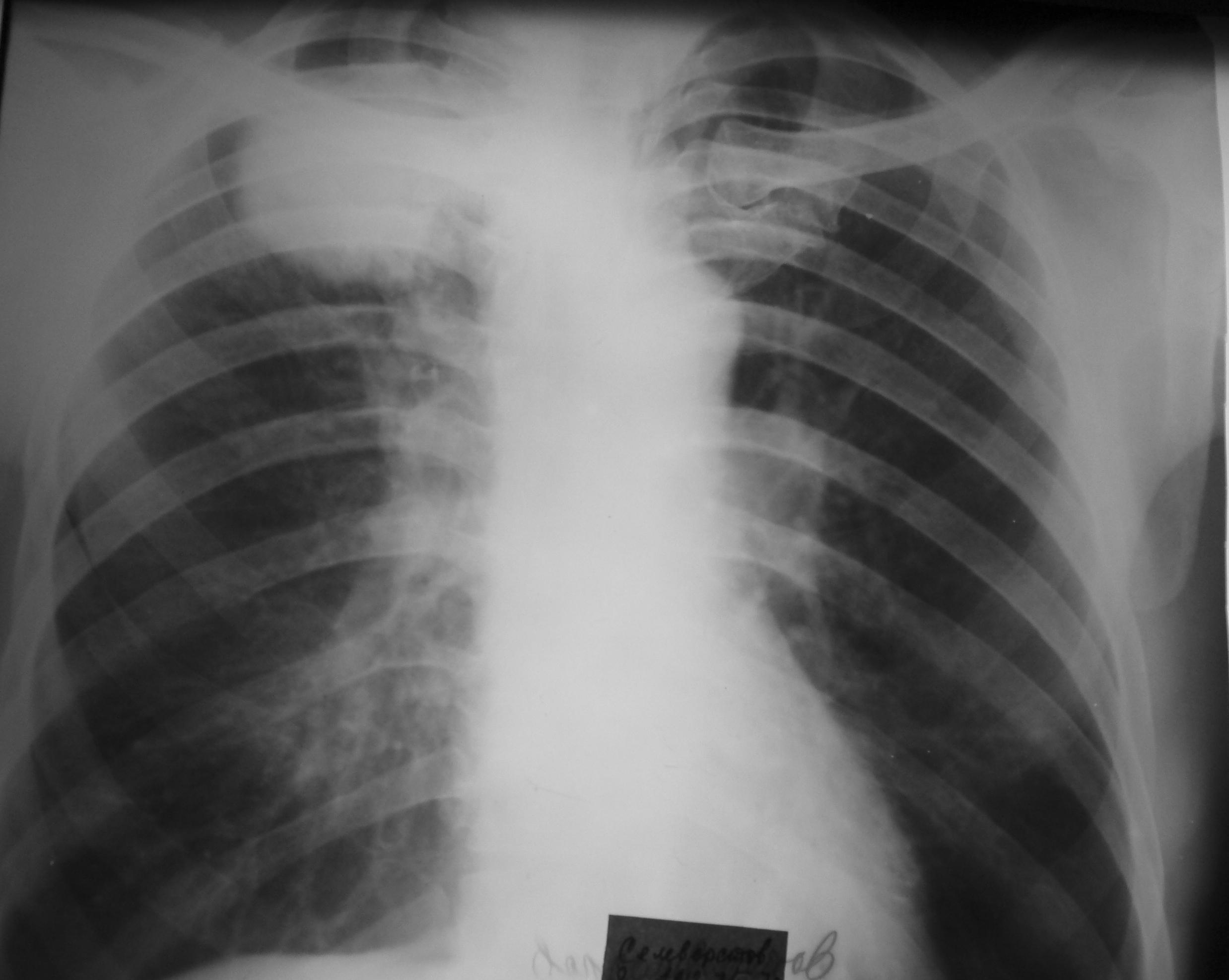 Округлое затемнение. Туберкулома рентген. Загрудинный зоб рентген. Круглые тени на рентгене легких.