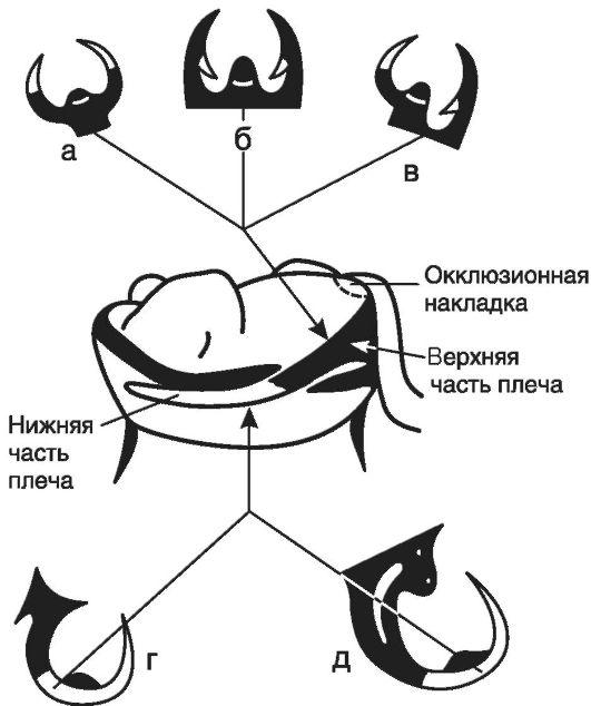 3.4. Клинико-биологические основы восстановления целостности зубных рядов бюгель