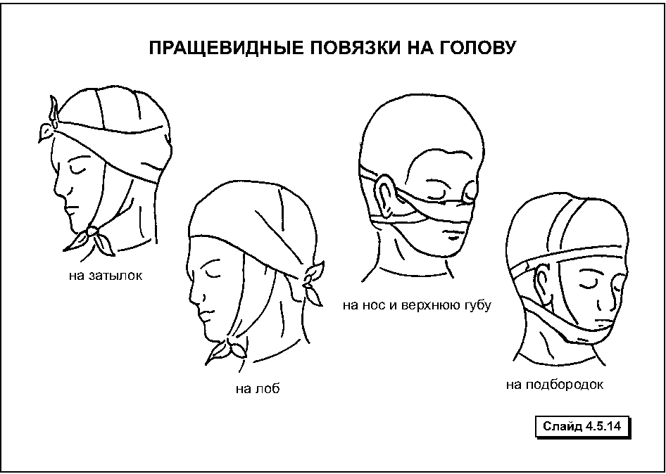 Посмотрите на рисунок 1 и подпишите типы бинтовых повязок