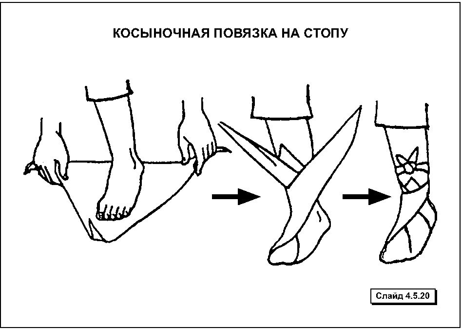 Косыночная повязка схема