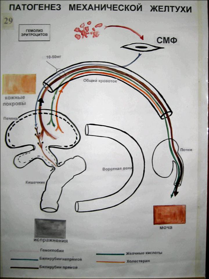 Патогенез механической желтухи схема
