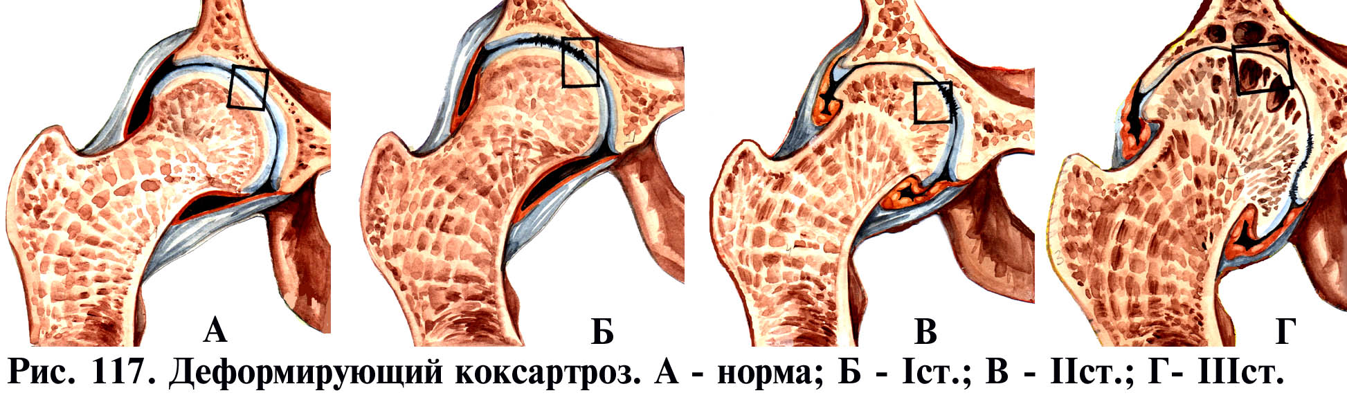 deformáló artrosis a kezekben az 1 fokozatú kezelés során