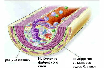 Роль липопротеинов в атеросклерозе thumbnail