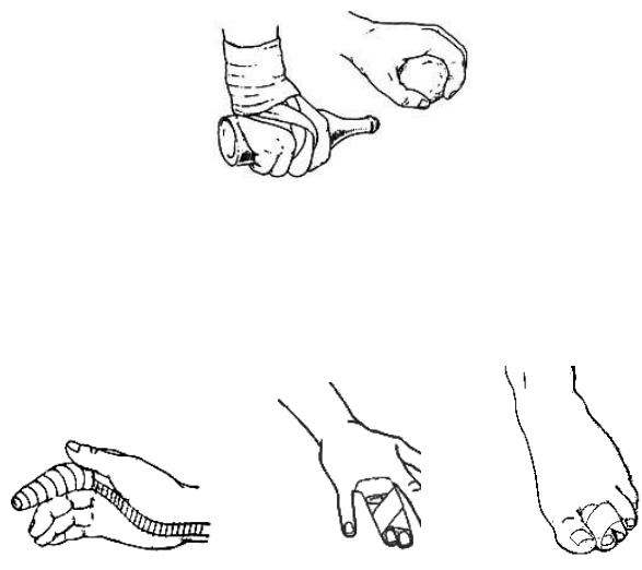 Иммобилизация пальца руки. Иммобилизация при переломе пальцев. Иммобилизация при переломе костей кисти и пальцев. Иммобилизация при переломе пальца руки. Иммобилизация конечности при переломе костей кисти и пальцев.