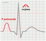 Экг синдром гипертрофия миокарда отделов сердца
