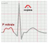 Экг синдром гипертрофия миокарда отделов сердца