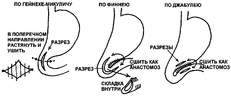 Пилоропластика по финнею схема