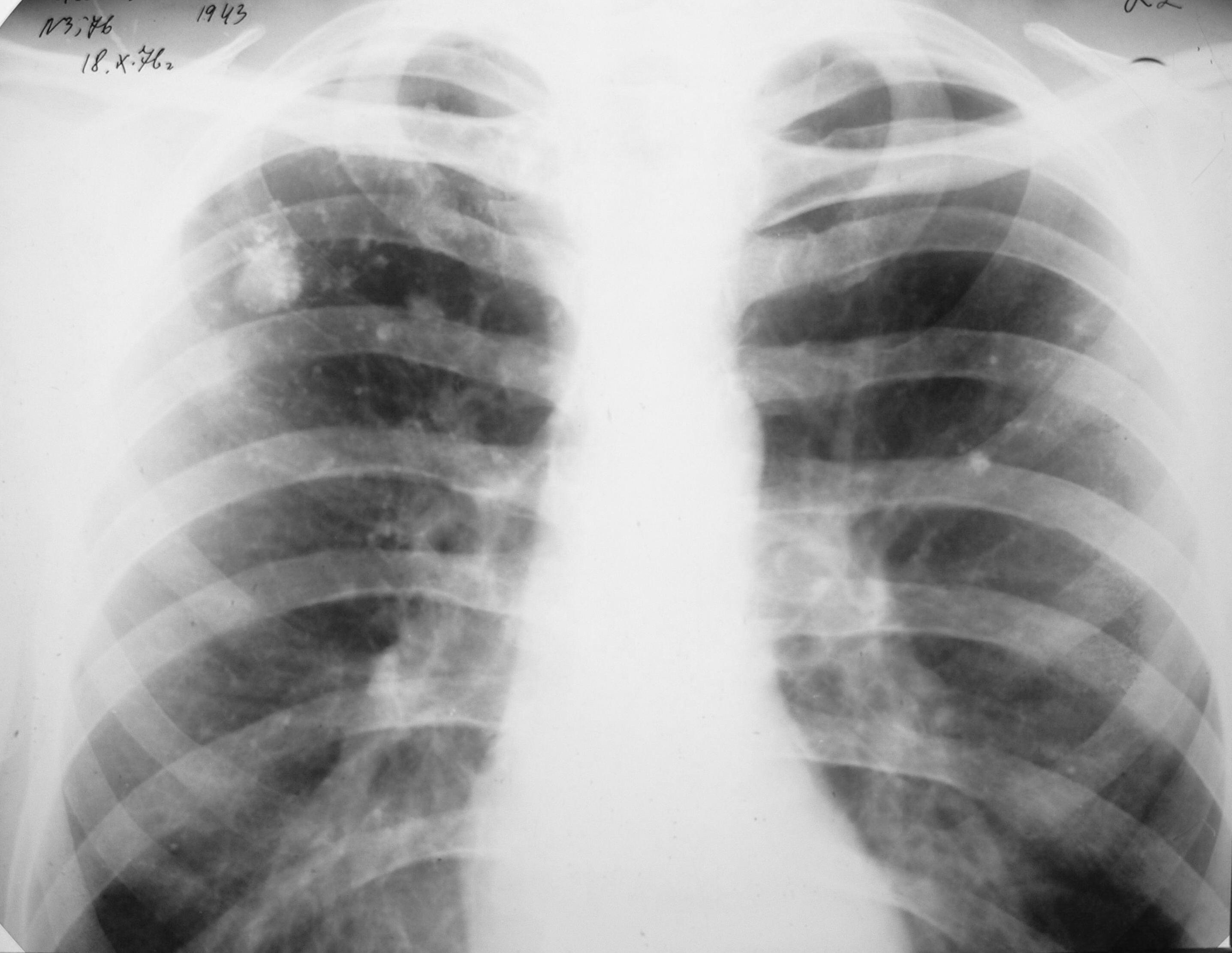 Туберкулез легкого рентгенограмма. Очаговые тени в легких на рентгене. Очаговый туберкулез рентген. Туберкулома на рентгенограмме. Синдром круглой тени туберкулома.