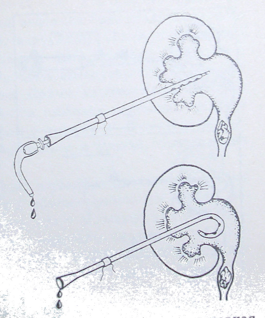 Нефростом. Чрескожной пункционной нефростомии. Нефростома чрескожная пункционная. Пункционная нефростомия техника.