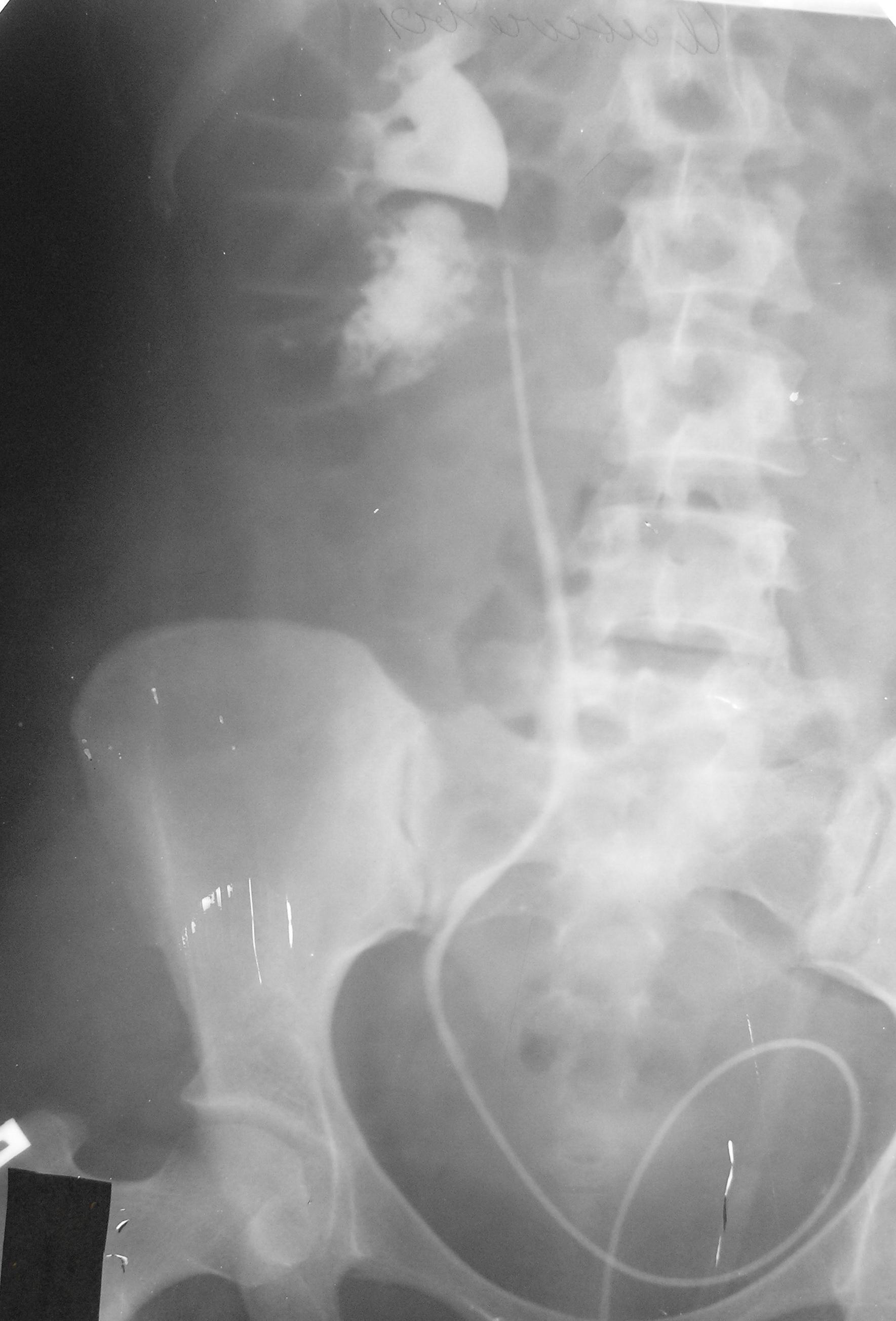 Рентген мочеточника. Стент в мочеточнике рентген. Травма почки экскреторная урография. Разрыв мочеточника рентген.