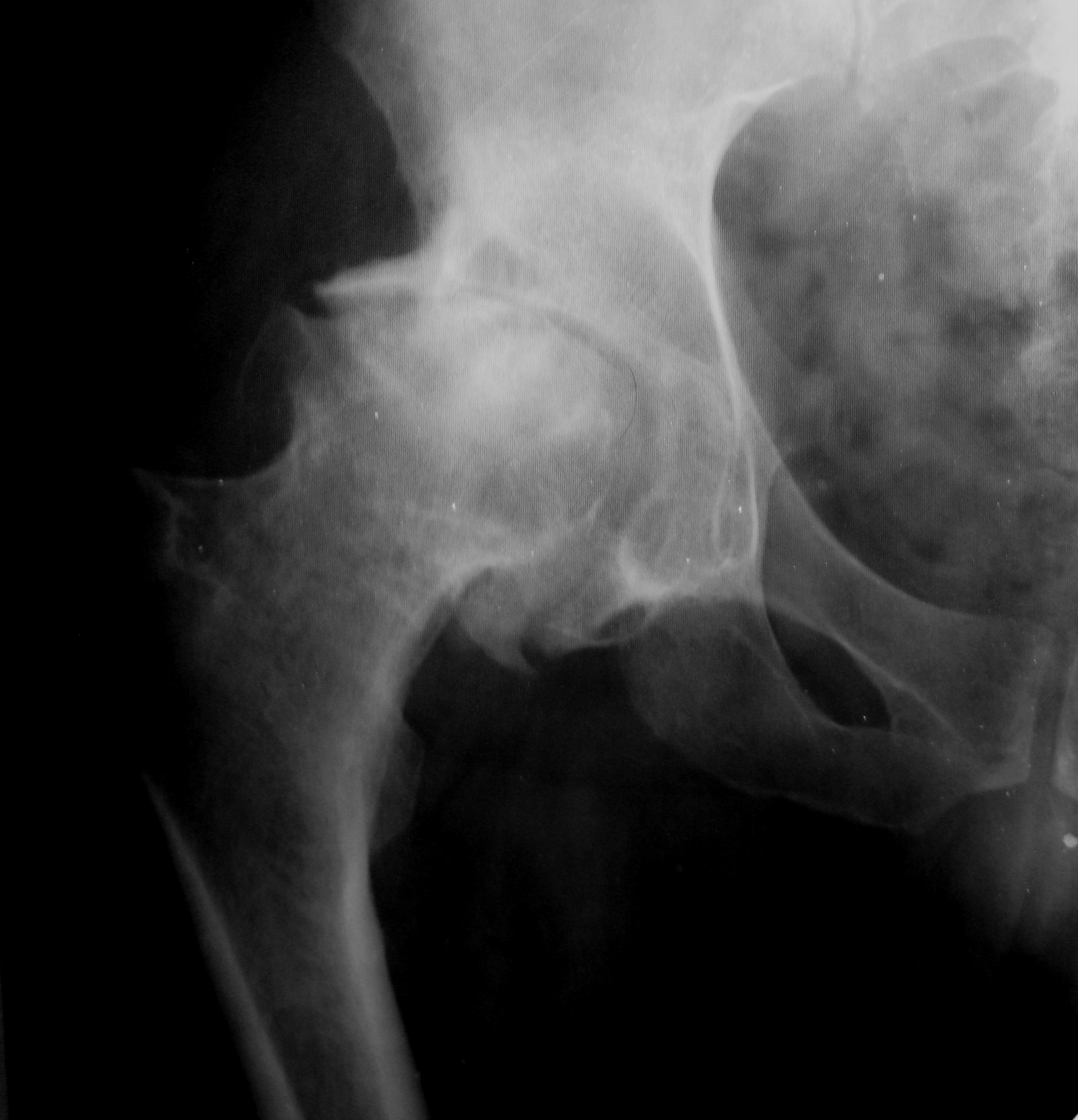 Патология тазобедренного сустава. Остеосклероз тазобедренного сустава рентген. Остеофиты головки бедренной кости. Очаговый остеосклероз бедренной кости. Остеопороз тазобедренного сустава рентген.