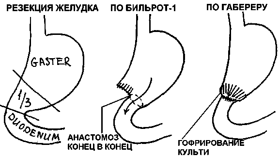 Резекция желудка схема