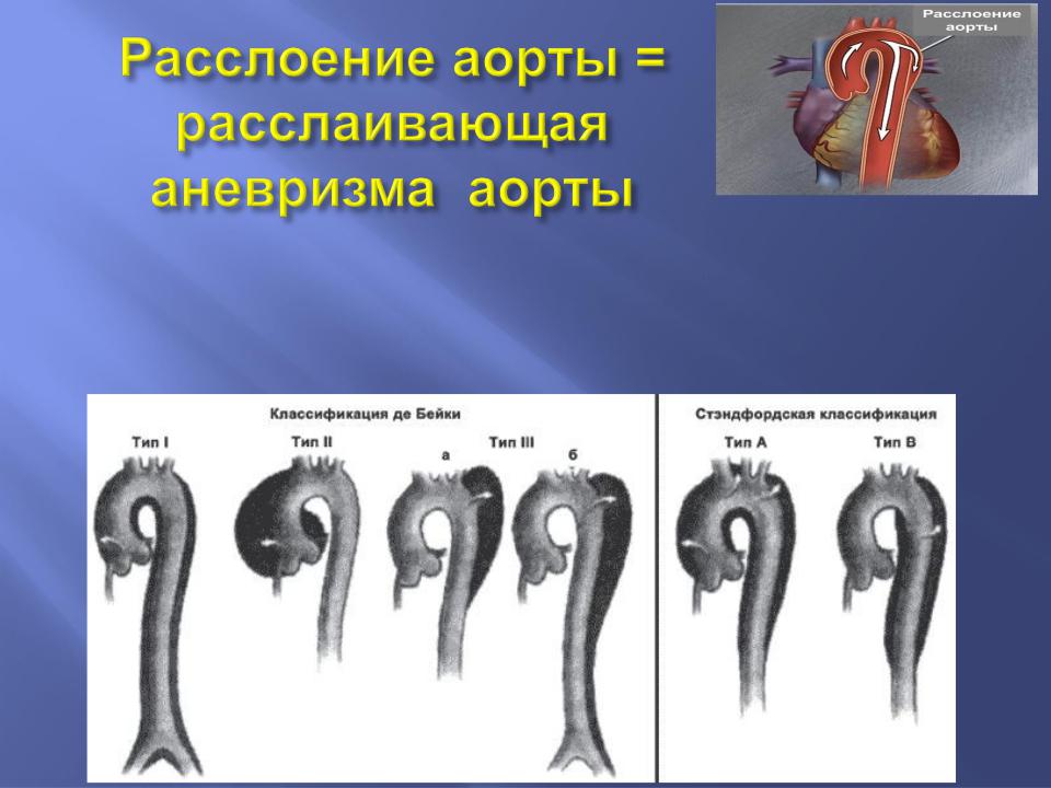 Расслоение аорты рекомендации