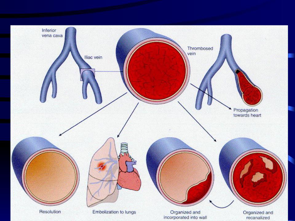 Тромб в правом. Исходы тромбоза патанатомия. Тромбоэмболия артерии.