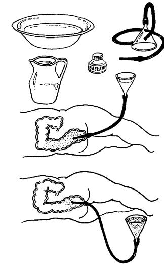Как ставить клизму самому себе. Сифонная клизма алгоритм. Постановка сифонной клизмы алгоритм. Сифонная клизма оснащение. Постановка сифонной клизмы.
