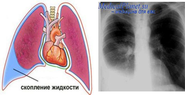 КЛИНИЧЕСКАЯ КАРТИНА