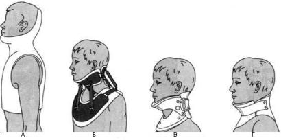 Наложение воротника шанца. Переломы шейных позвонков воротник Шанца. Иммобилизация шейного отдела позвоночника. Шейный воротник иммобилизация.