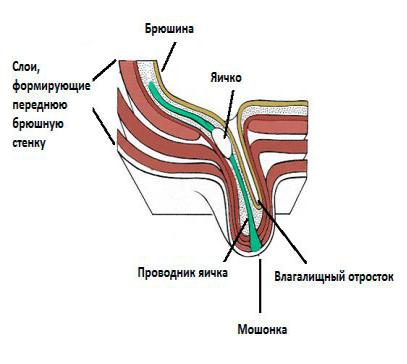 Гидроцеле у детей