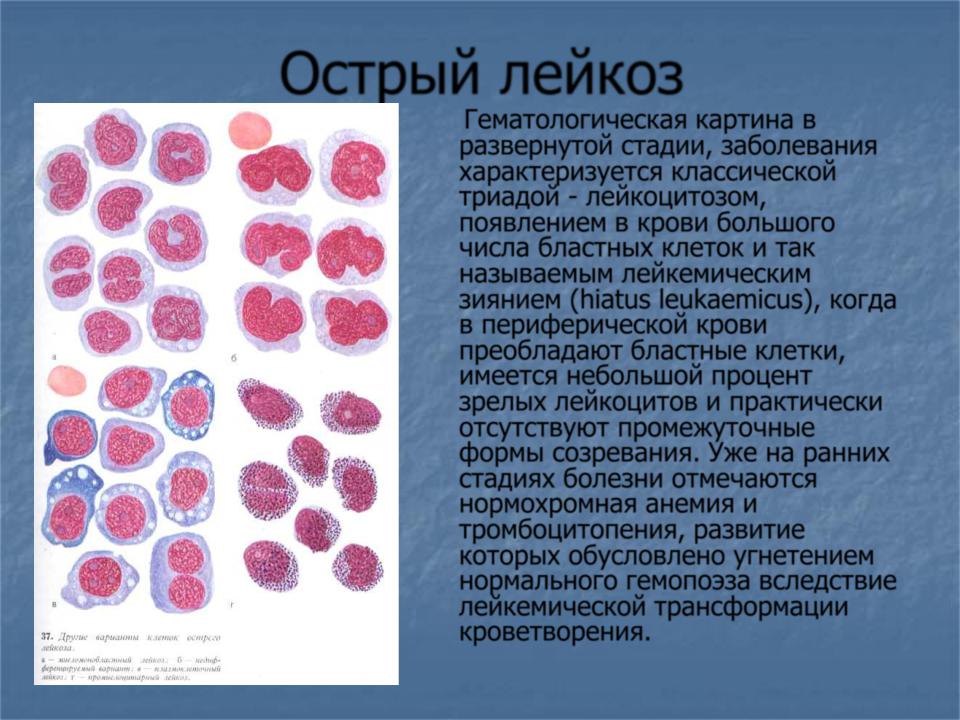 Лейкоз характеризуется. Острый лейкоз бластные клетки. Бластные клетки в крови при лейкозе. Бластные клетки хронический лейкоз. Бластные клетки 88% в крови.