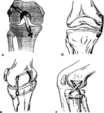 Операция колено пкс. Якорная фиксация крестообразной связки коленного сустава. Разрыв ПКС коленного сустава операция. Разрыв связок коленного сустава ПКС операция. Пластика передней крестообразной связки коленного сустава методика.