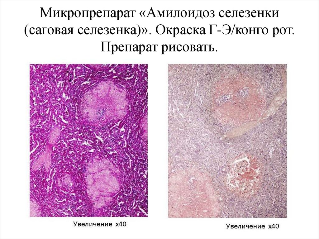 Как выглядит рак селезенки Клиническая классификация