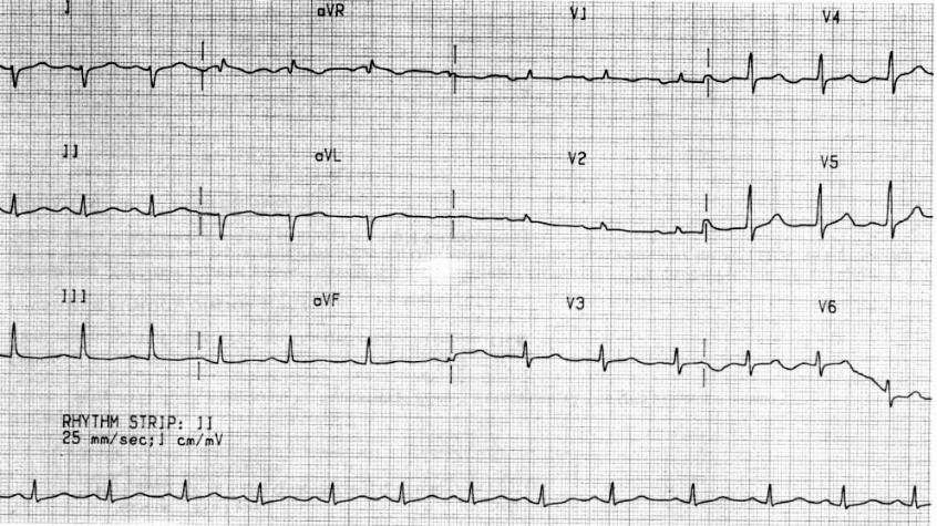 Эпсилон волна на ЭКГ. J point ECG. Ventricular Fibrillation ECG. Complete Heart Block. Очаговые изменения желудочка