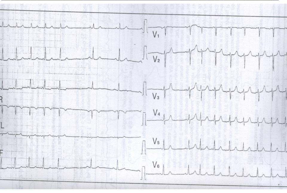 Avr avf Avr avf